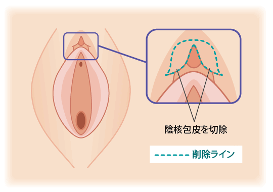いん しん 縮小 適用 しょう 手術 保険 小陰唇や膣縮小などの婦人科形成治療